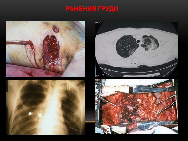 РАНЕНИЯ ГРУДИ